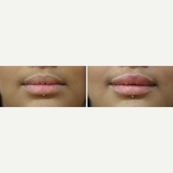 Juvederm - Volbella Lip Enhancement before 3375290