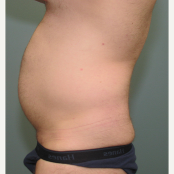 35-44 year old man treated with Smart Lipo before 3237005