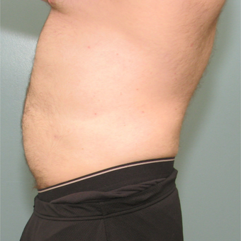 35-44 year old man treated with Smart Lipo after 3237005