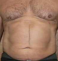 VASER liposuction of abdominal wall before 384689