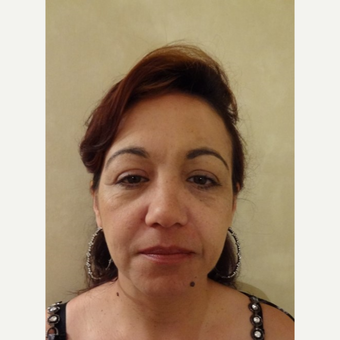 45-54 year old woman treated with Liquid Facelift before 3744566