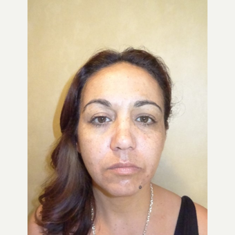 45-54 year old woman treated with Liquid Facelift after 3744566