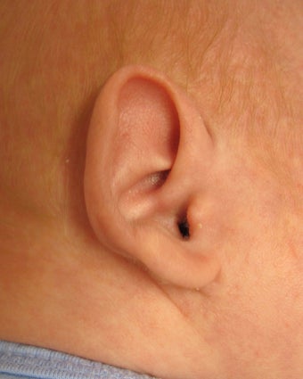 Newborn with ear abnormality. before 1271207