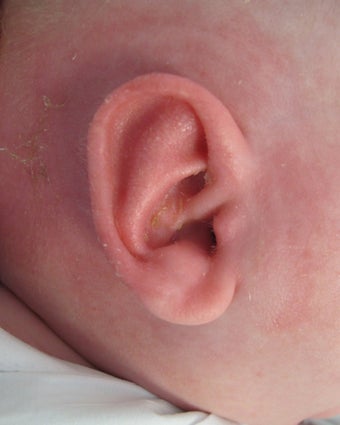 Newborn with ear abnormality. after 1271207
