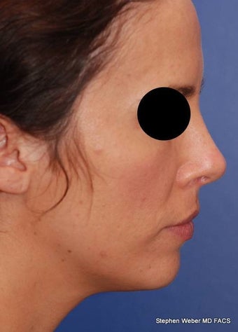 25-34 year old woman treated with Rhinoplasty after 3624194