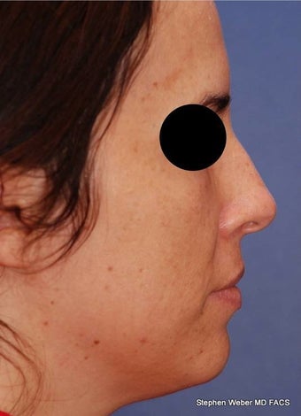 25-34 year old woman treated with Rhinoplasty before 3624194