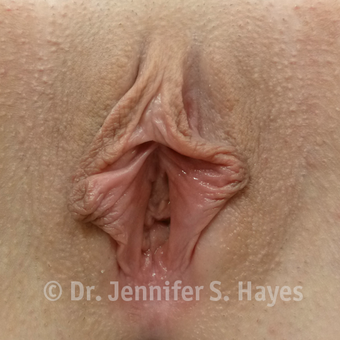 25-34 year old woman treated with Labiaplasty before 3459360