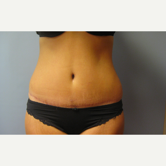 25-34 year old woman treated with Tummy Tuck after 3108202