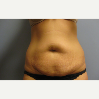 25-34 year old woman treated with Tummy Tuck before 3108202