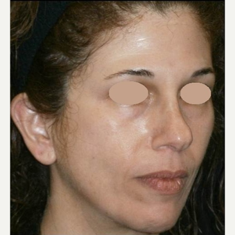 45-54 year old woman treated with Skin Lightening after 3089505