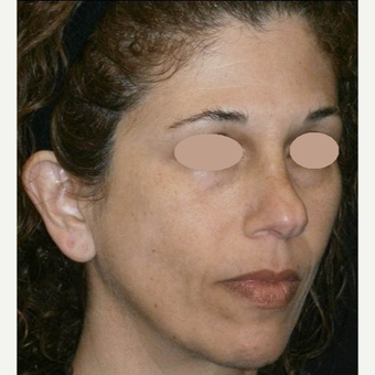 45-54 year old woman treated with Skin Lightening before 3089505