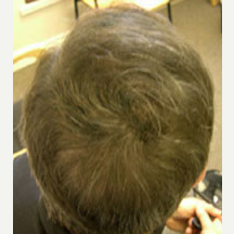 53 year old male treated with Hair Transplant after 3839268