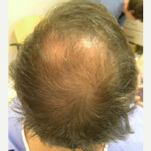 53 year old male treated with Hair Transplant before 3839268