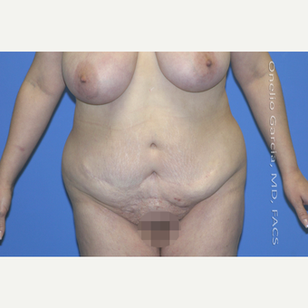 45-54 year old woman treated with Body Lift-Circumferential "Belt" lipectomy + Vaser Liposuction before 3041522
