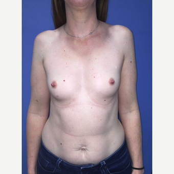 35-44 year old woman treated with Breast Augmentation before 3759809