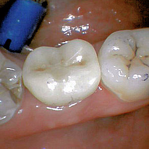 Boken tooth replaced with immeidate dental implants after 3696418