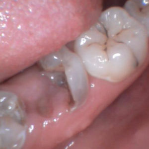 Boken tooth replaced with immeidate dental implants before 3696418
