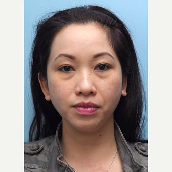 Eye Bags Treatment Using Restylane before 2014063