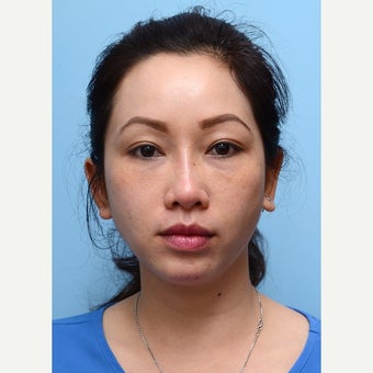 Eye Bags Treatment Using Restylane after 2014063