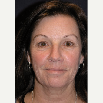 55-64 year old woman treated with Eye Bags Treatment before 3466673