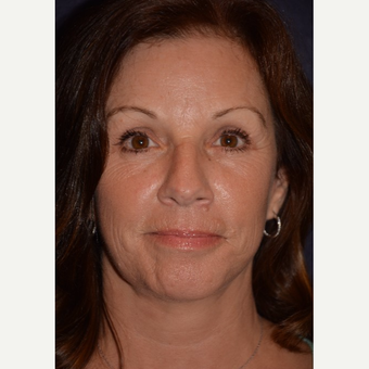 55-64 year old woman treated with Eye Bags Treatment after 3466673