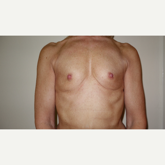 45-54 year old woman treated with Breast Augmentation before 3031296