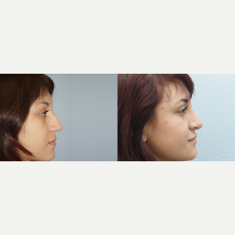 17 yr old Female - Rhinoplasty after 3100017