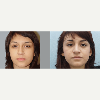 17 yr old Female - Rhinoplasty before 3100017