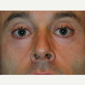 45-54 year old man treated with Chemical Peel after 3646113