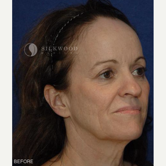45-54 year old woman treated with Forehead Reduction, Facelift, Rhinoplasty before 2900463