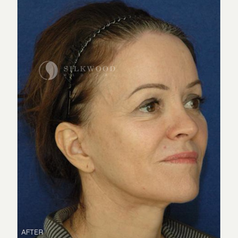 45-54 year old woman treated with Forehead Reduction, Facelift, Rhinoplasty after 2900463
