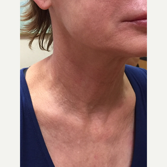 55-64 year old woman treated with Infini RF before 3566195