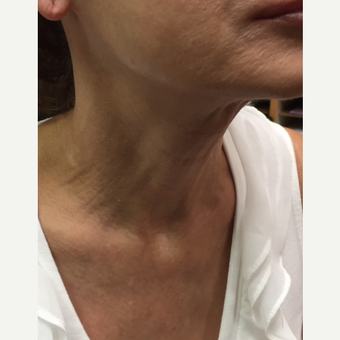 55-64 year old woman treated with Infini RF after 3566195