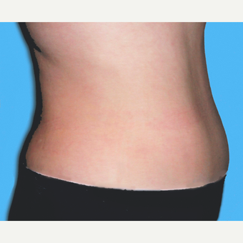 Liposuction after 3810458