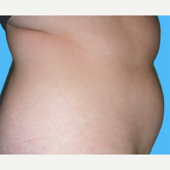 Liposuction before 3810458