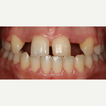 25-34 year old woman treated with Dental Implants before 2807097