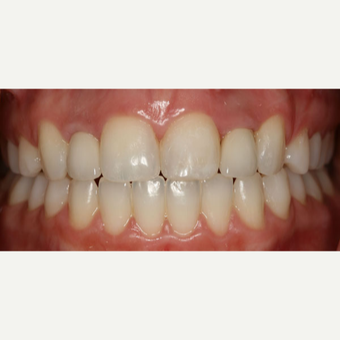 25-34 year old woman treated with Dental Implants after 2807097