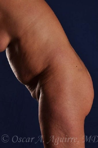 53 yo had Smart Lipo; Upper/Lower Abdomen, Mons, Hips, Lower Back (View 1&2) 2094986