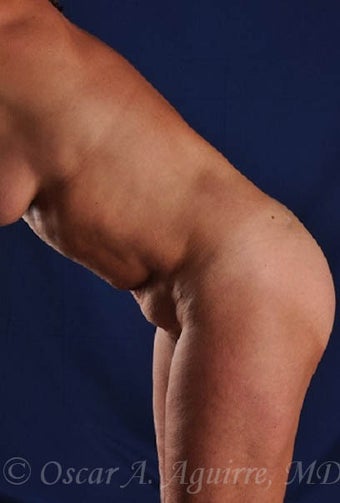 53 yo had Smart Lipo; Upper/Lower Abdomen, Mons, Hips, Lower Back (View 1&2) 2094986