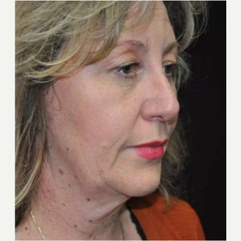 45-54 year old woman treated with Neck Lift before 1577050