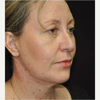 45-54 year old woman treated with Neck Lift after 1577050