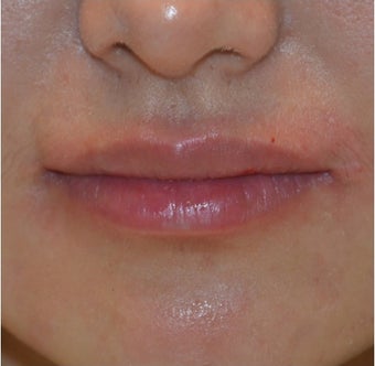 23 Year Old Female Treated for Lip Augmentation after 1373416