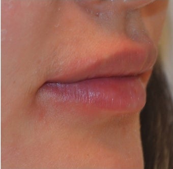 23 Year Old Female Treated for Lip Augmentation 1373416