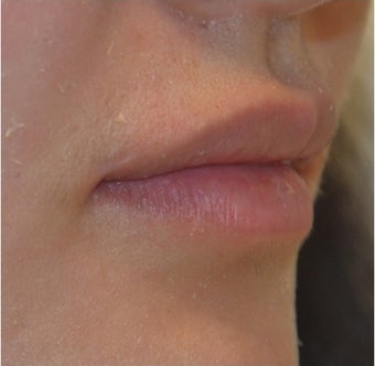23 Year Old Female Treated for Lip Augmentation 1373416