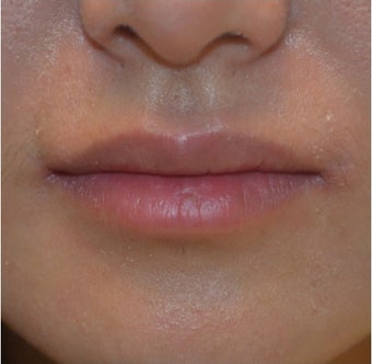 23 Year Old Female Treated for Lip Augmentation before 1373416