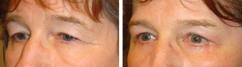 Eyebrow Lift before 1167823