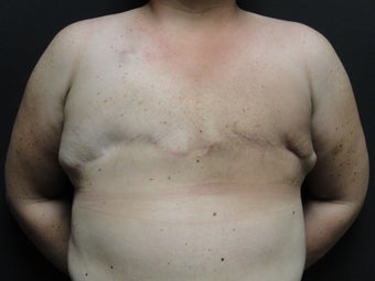 Flap-based breast reconstruction - DIEP before 867409