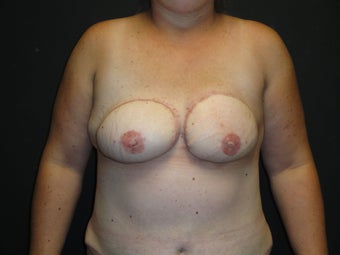 Flap-based breast reconstruction - DIEP after 867409