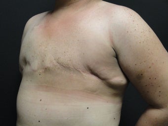 Flap-based breast reconstruction - DIEP 867409
