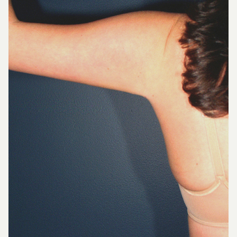 25-34 year old woman treated with Liposuction - arms improved after 3664487